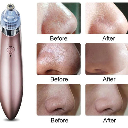 ✨ 4-in-1 Pro Multi-Function Blackhead & Whitehead Remover™